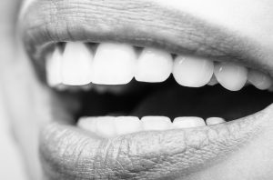 Como se hace un blanqueamiento dental